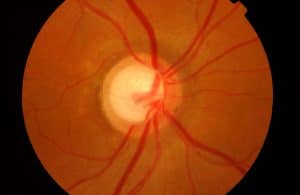 Glaucoma 青光眼