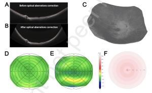 Retinal Curvature and Ocular Biometric Changes in Adult High Myopia: Insights from Ss-Oct/Octa