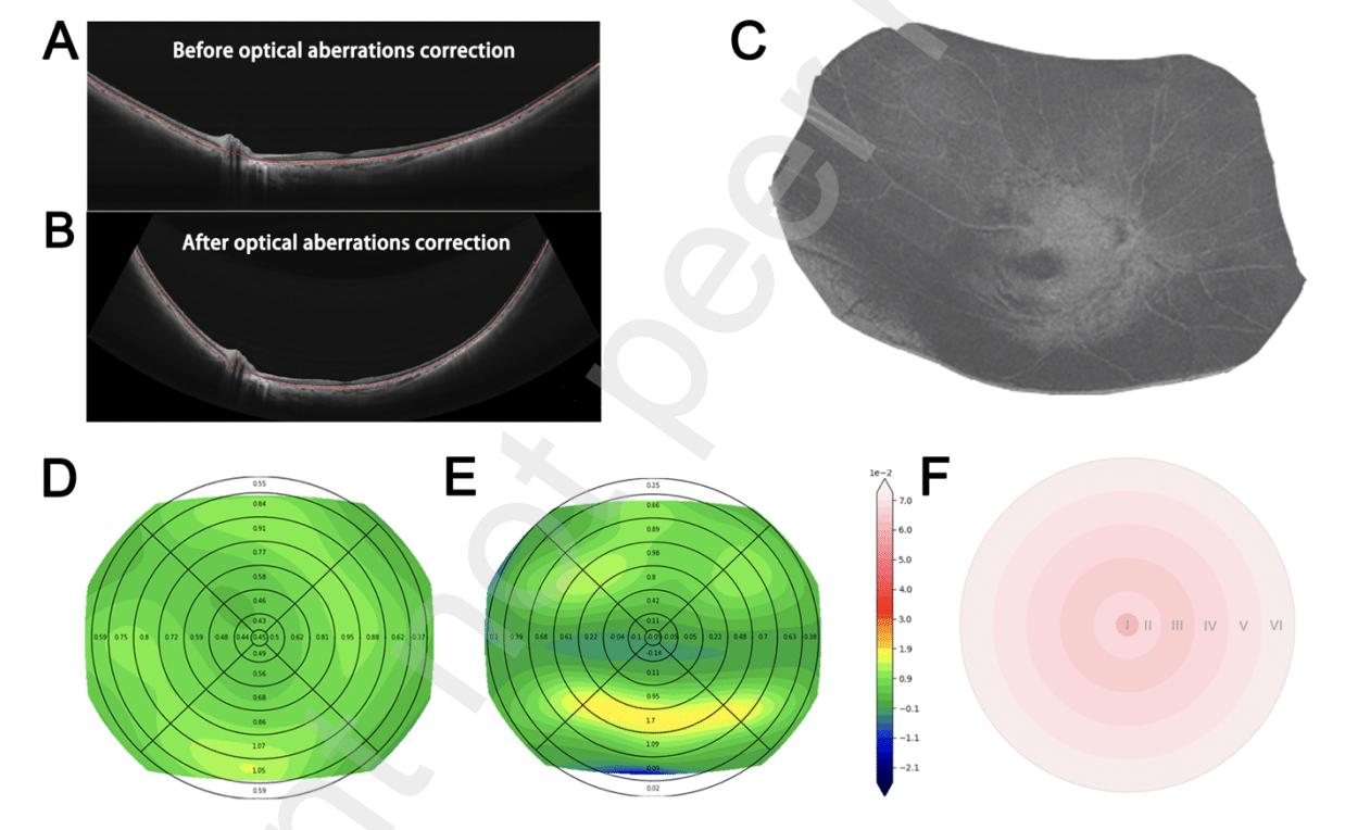 Retinal Curvature and Ocular Biometric Changes in Adult High Myopia: Insights from Ss-Oct/Octa