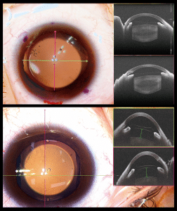 Cataracts diagnosis-treatment 白內障的治療